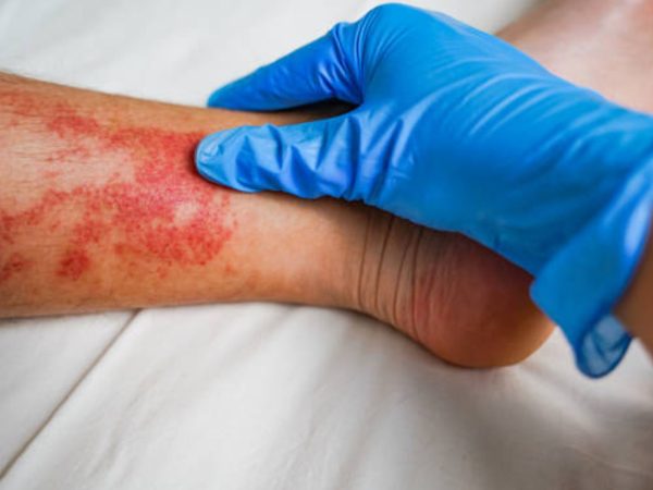 Turf Burn Infection: Long-Term Implications and Effective Prevention Strategies