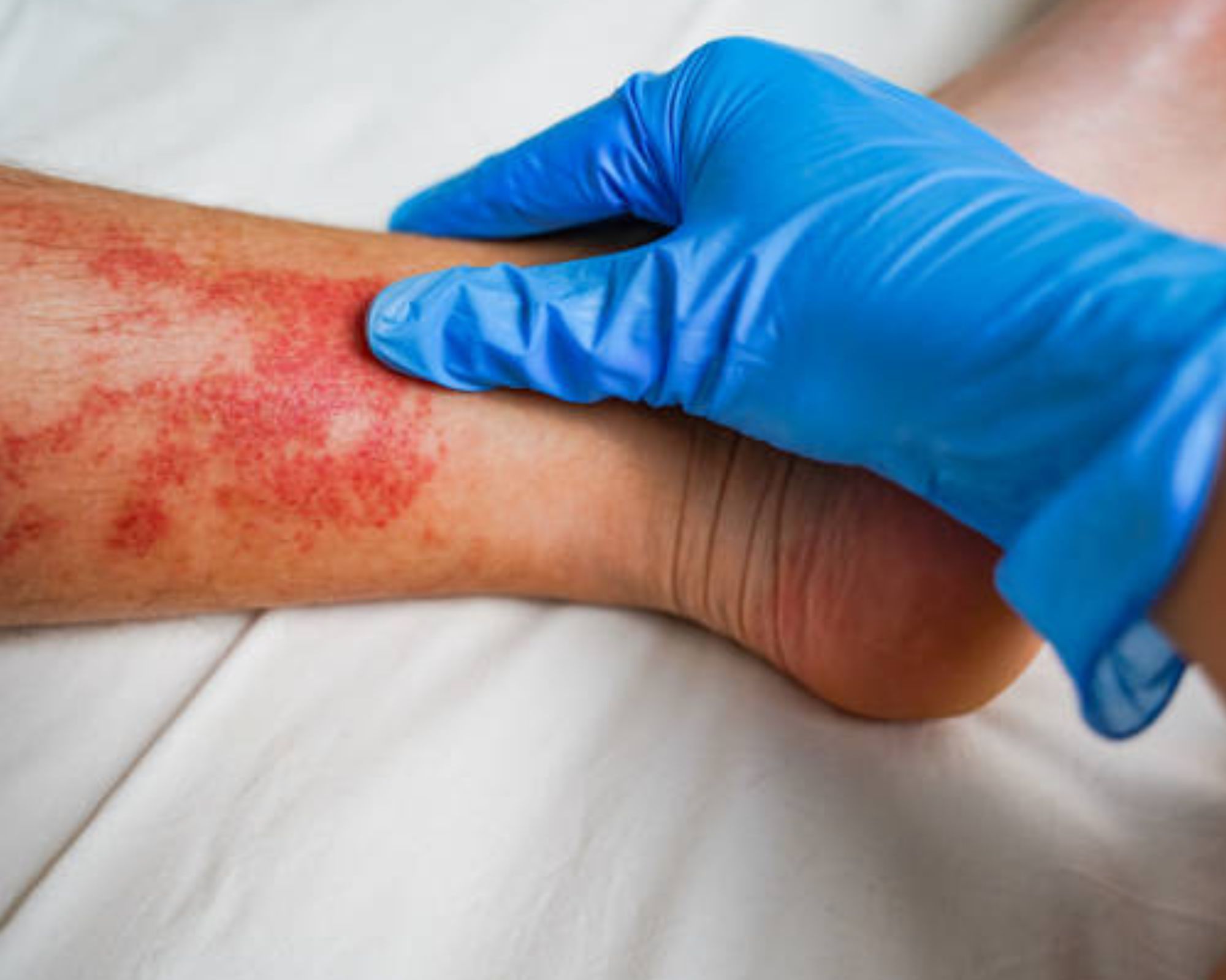 Turf Burn Infection: Long-Term Implications and Effective Prevention Strategies